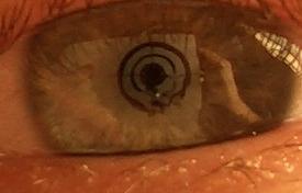 improvisiertes - Hornhautlaesion (l)/improvised Keratoscope (drawing on carton, shot using the macro mode of a not too recent digital point and click camera) improvisiertes - Hornhautlaesion (l)/improvised Keratoscope (drawing on carton, shot using the macro mode of a not too recent digital point and click camera)